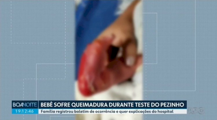 Hospital e Conselho de Enfermagem apuram caso de bebê que teria sofrido queimadura durante teste do pezinho